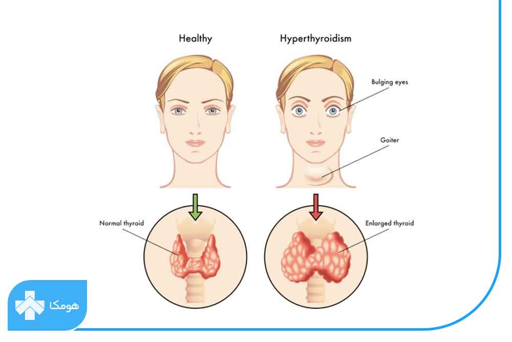 علائم پرکاری تیروئید