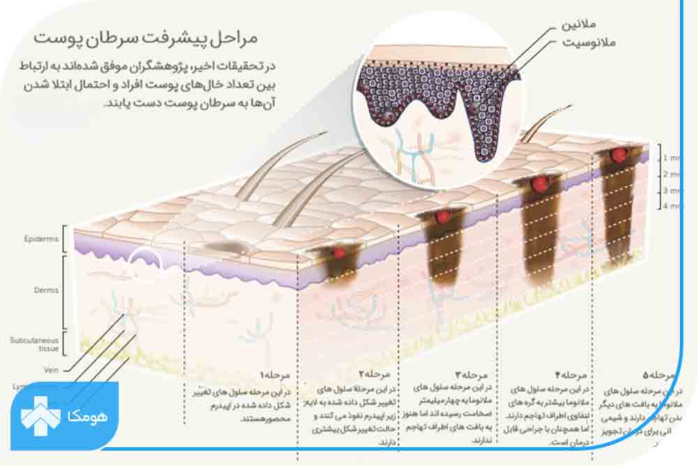 مراحل پیشرفت سرطان پوست