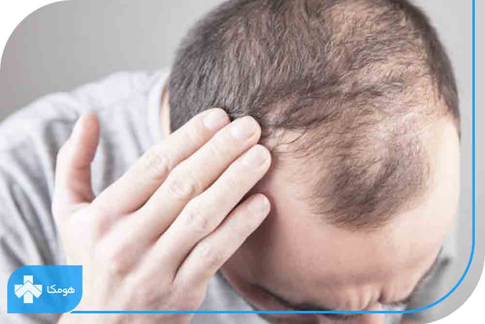 ریزش مو با الگوی مردانه چیست؟