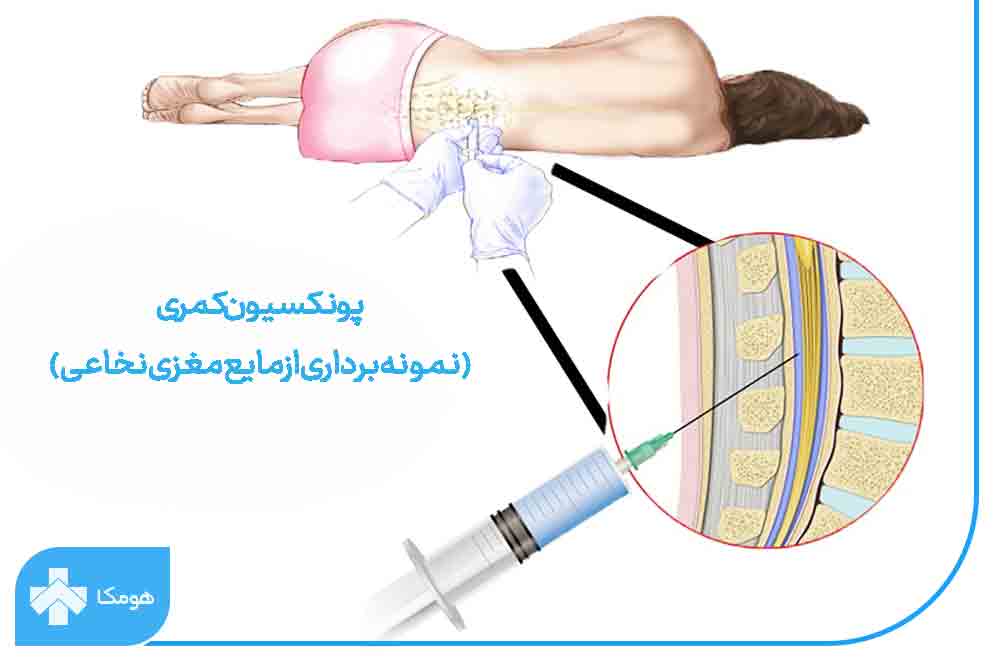 استفاده از پونکسیون کمری برای تشخیص ام اس