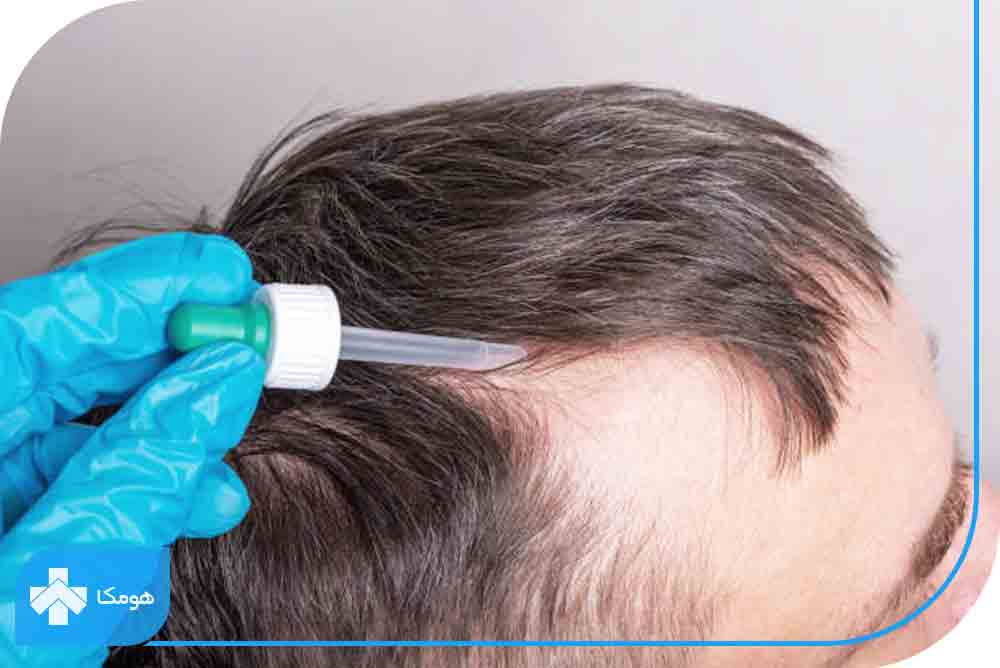 ماینوکسیدیل موضعی برای درمان ریزش موی مردان