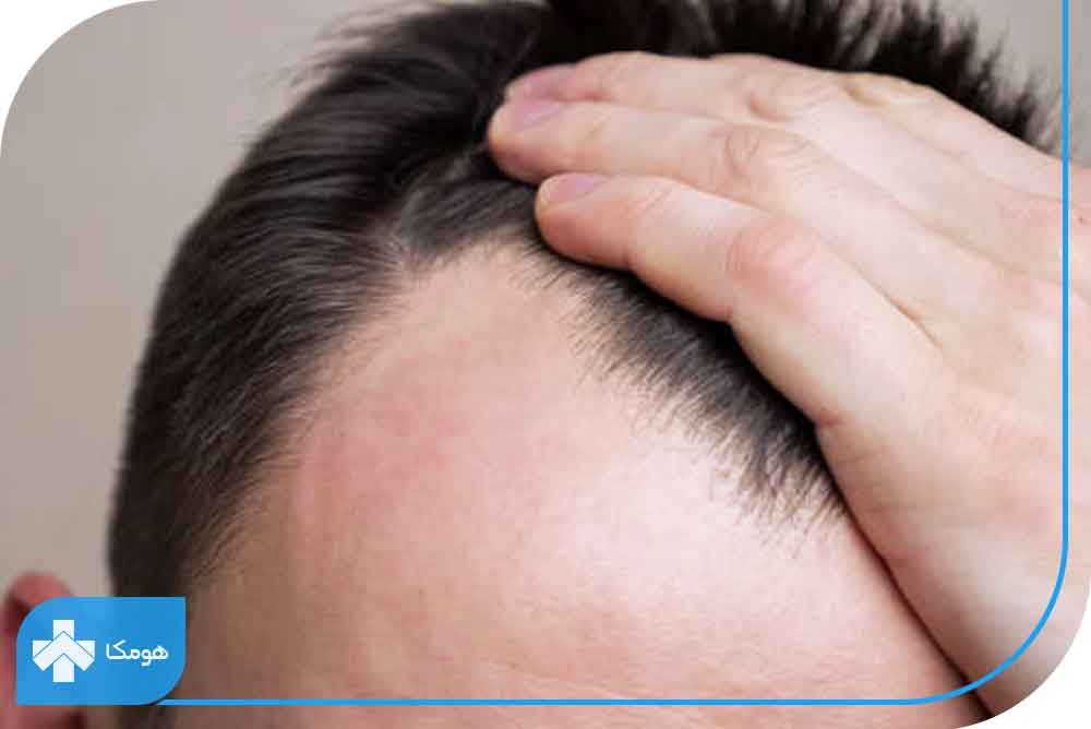 درمان ریزش موی جلوی سر