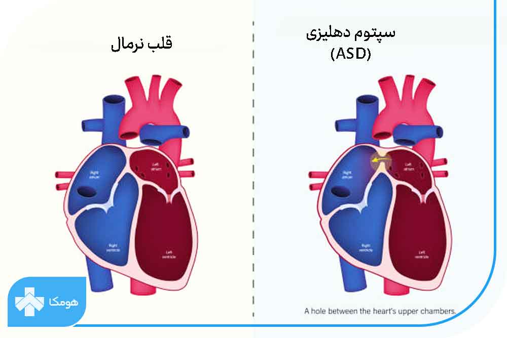 سپتوم دهلیزی