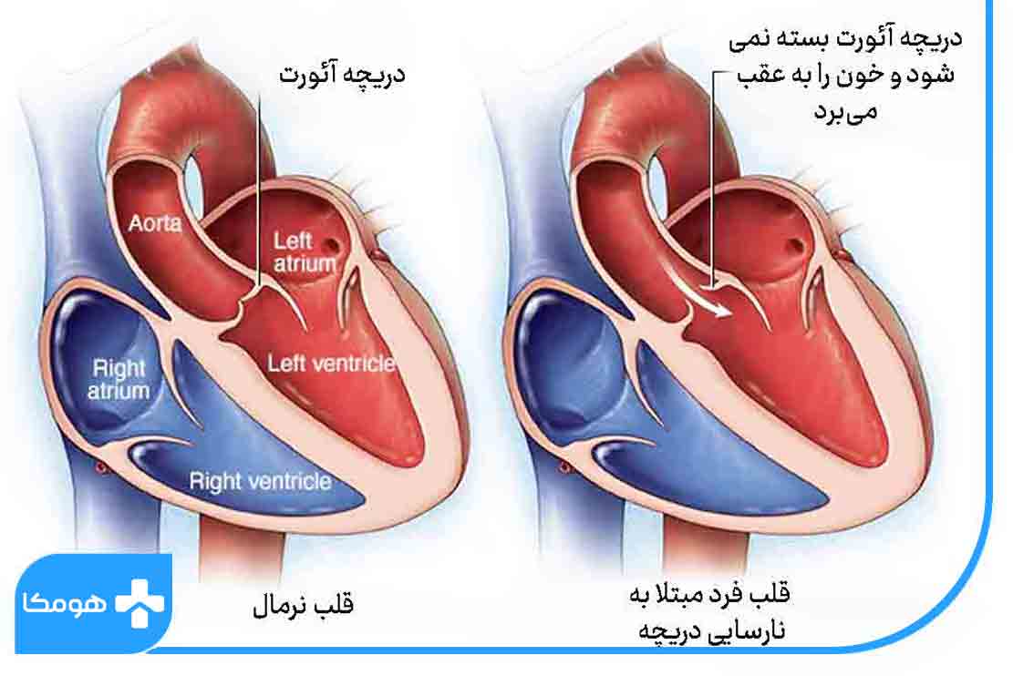 بیماری دریچه‌ای قلب