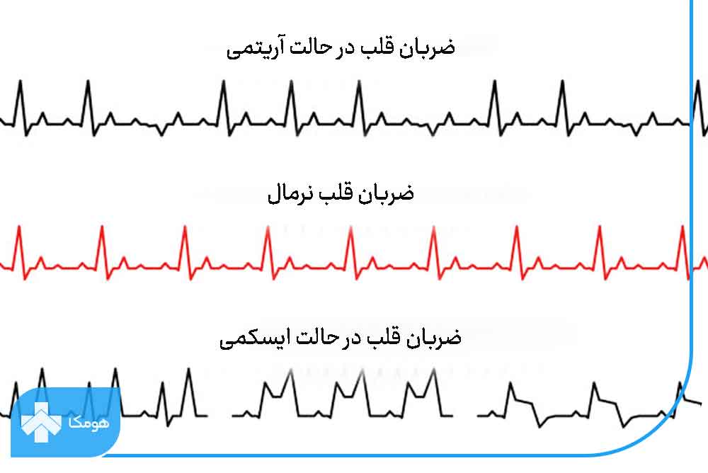 مشکل قلبی در نوار قلب