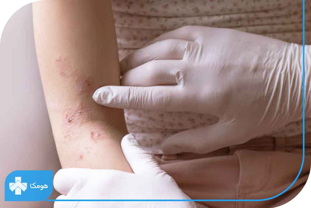 چگونه از بروز واکنش‌های آلرژی جلوگیری کنیم؟