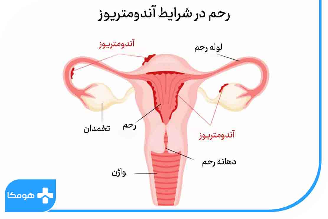 اندومتریوز و درد در تخمدان