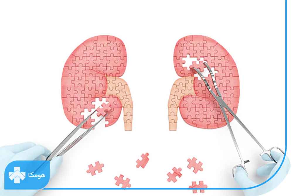 کیست کلیه چیست؟