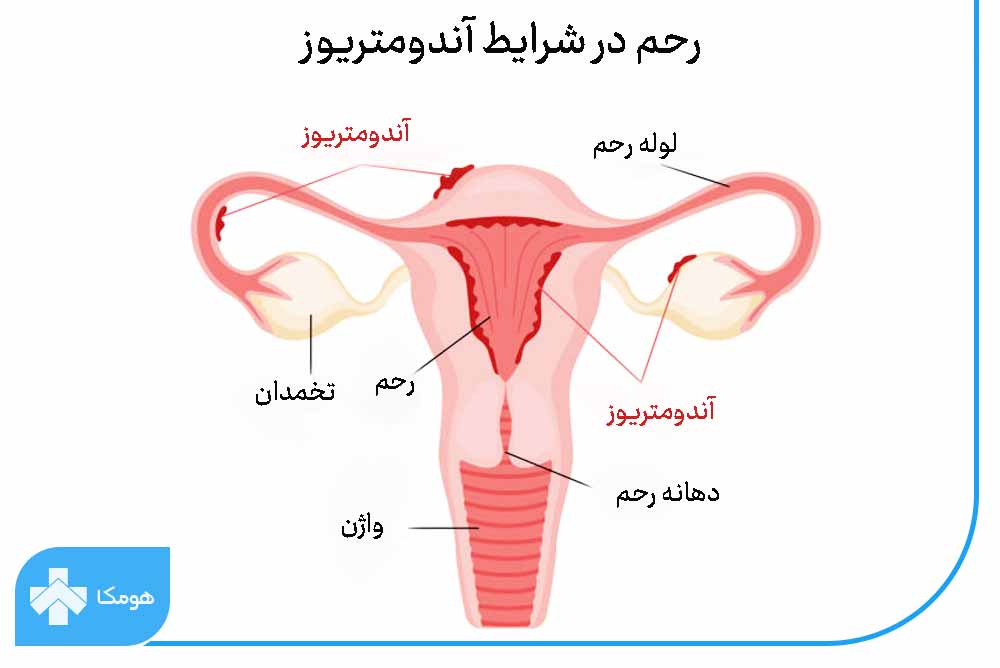 علت آندومتریوز