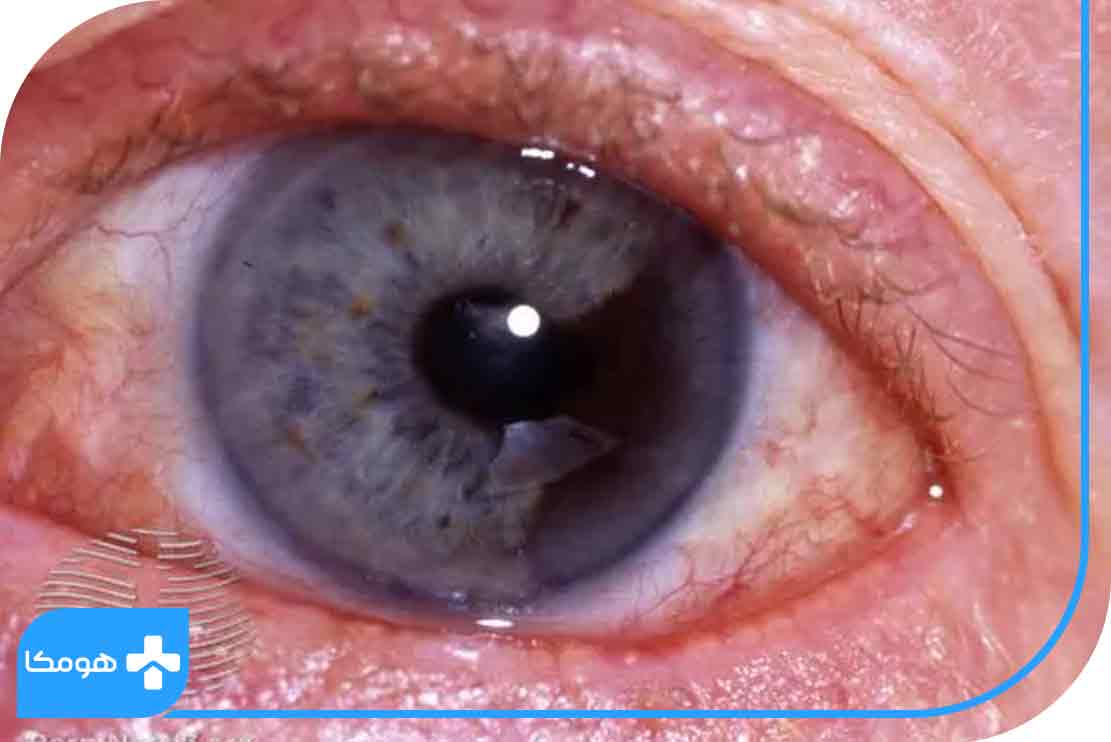 علل بروز تومورهای چشمی