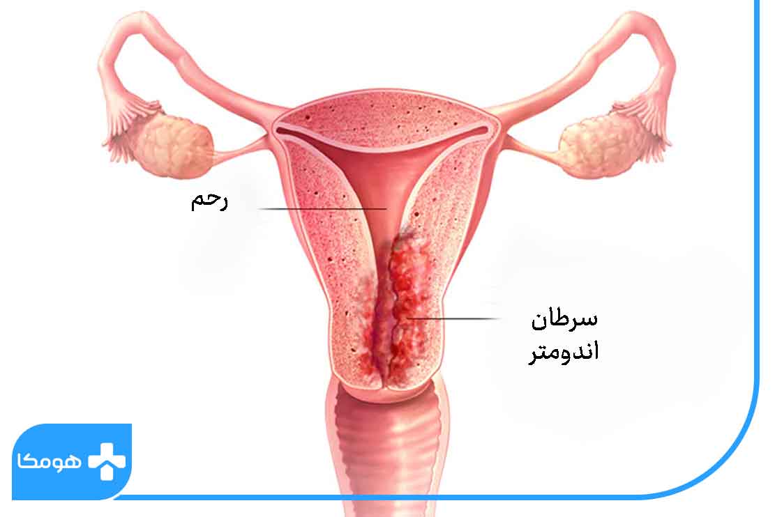 انواع سرطان رحم