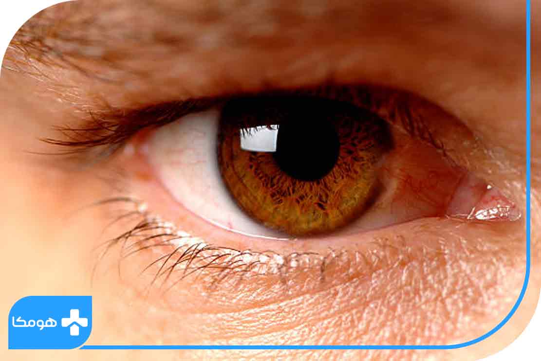 تومورهای چشم