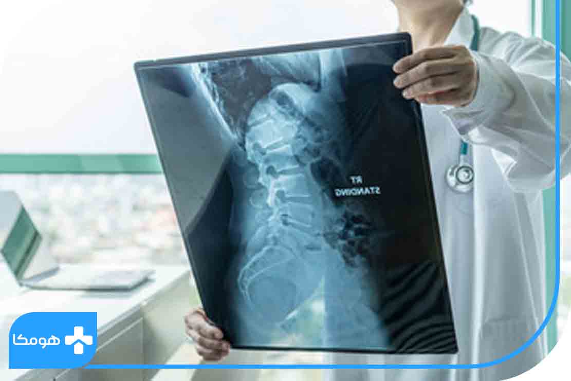 انواع تومورهای ستون فقرات
