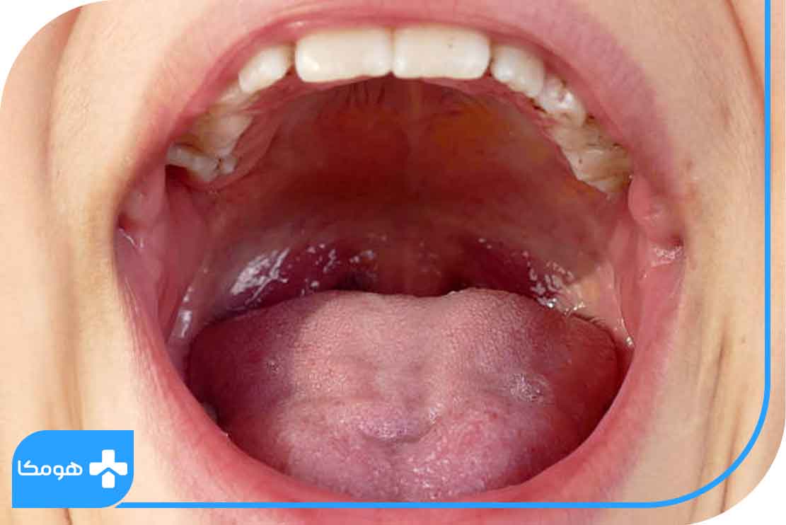 سنگ لوزه چیست؟