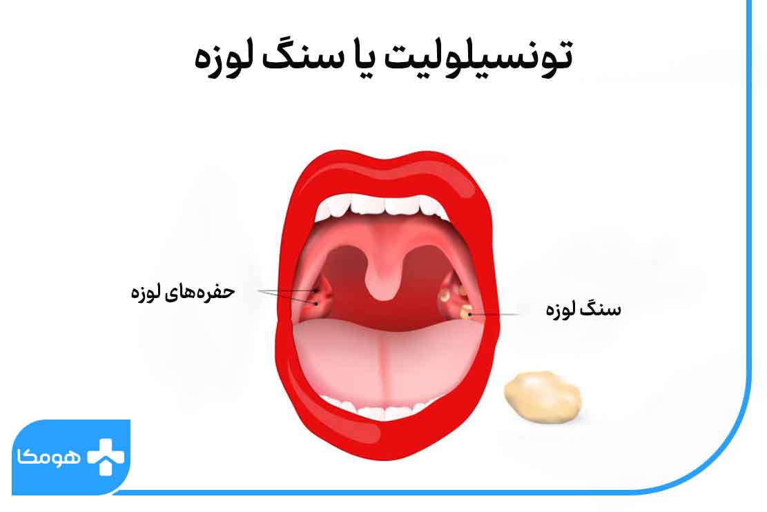 سنگ لوزه چه علائمی دارد؟