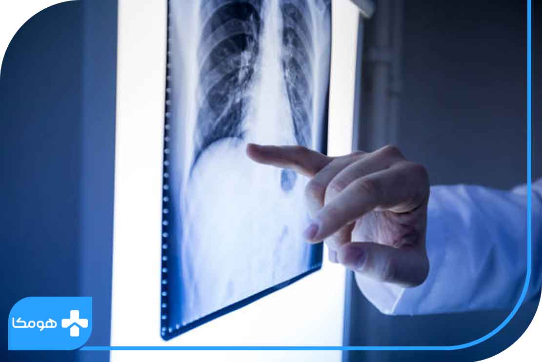 تومور استخوانی چیست؟