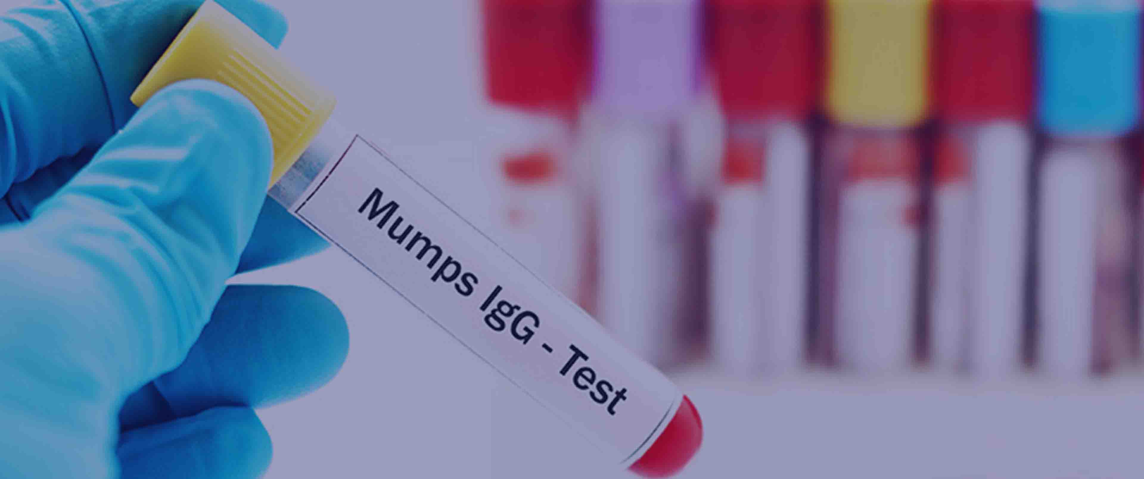 آزمایش Mumps IgG/IgM