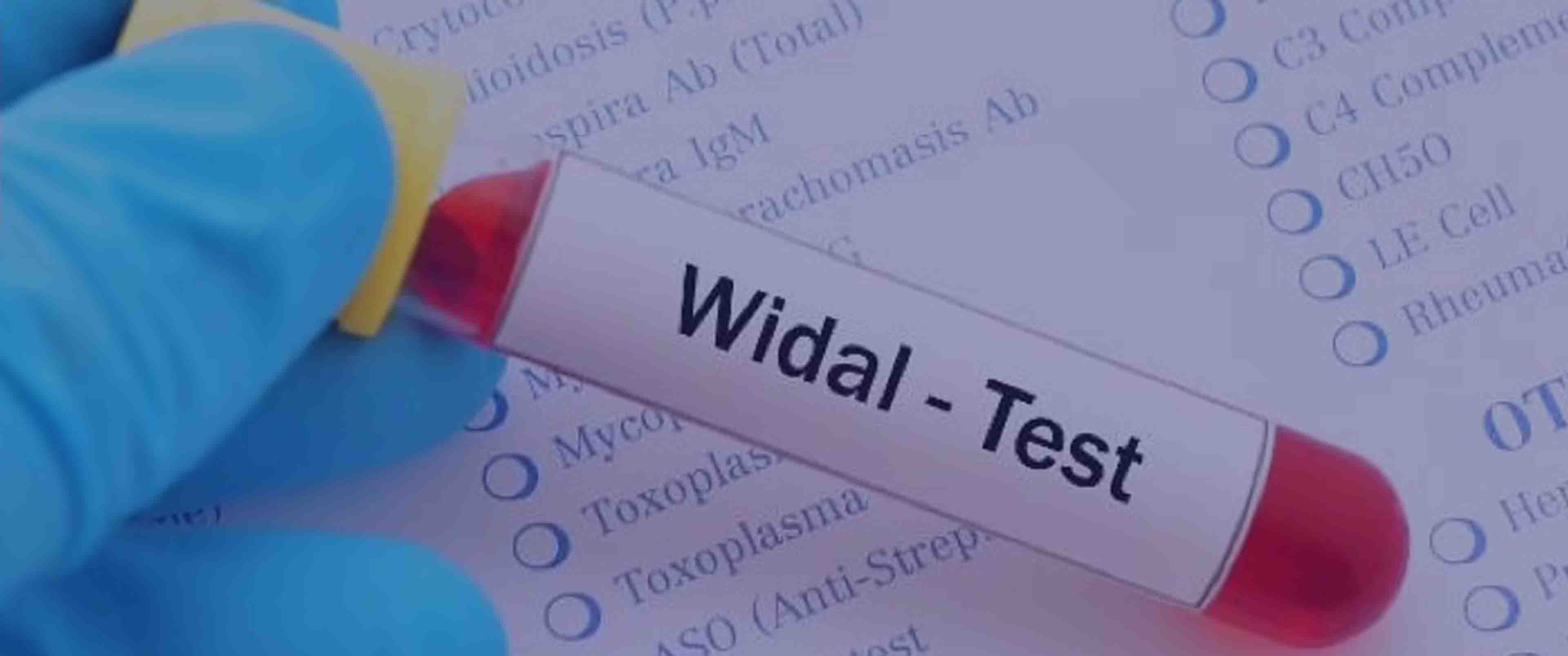 آزمایش Widal