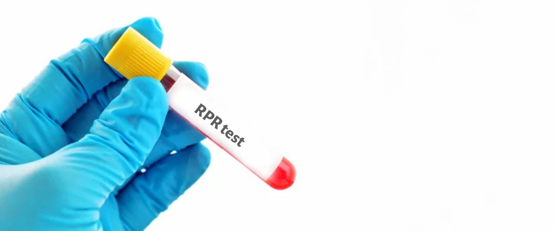 آزمایش RPR