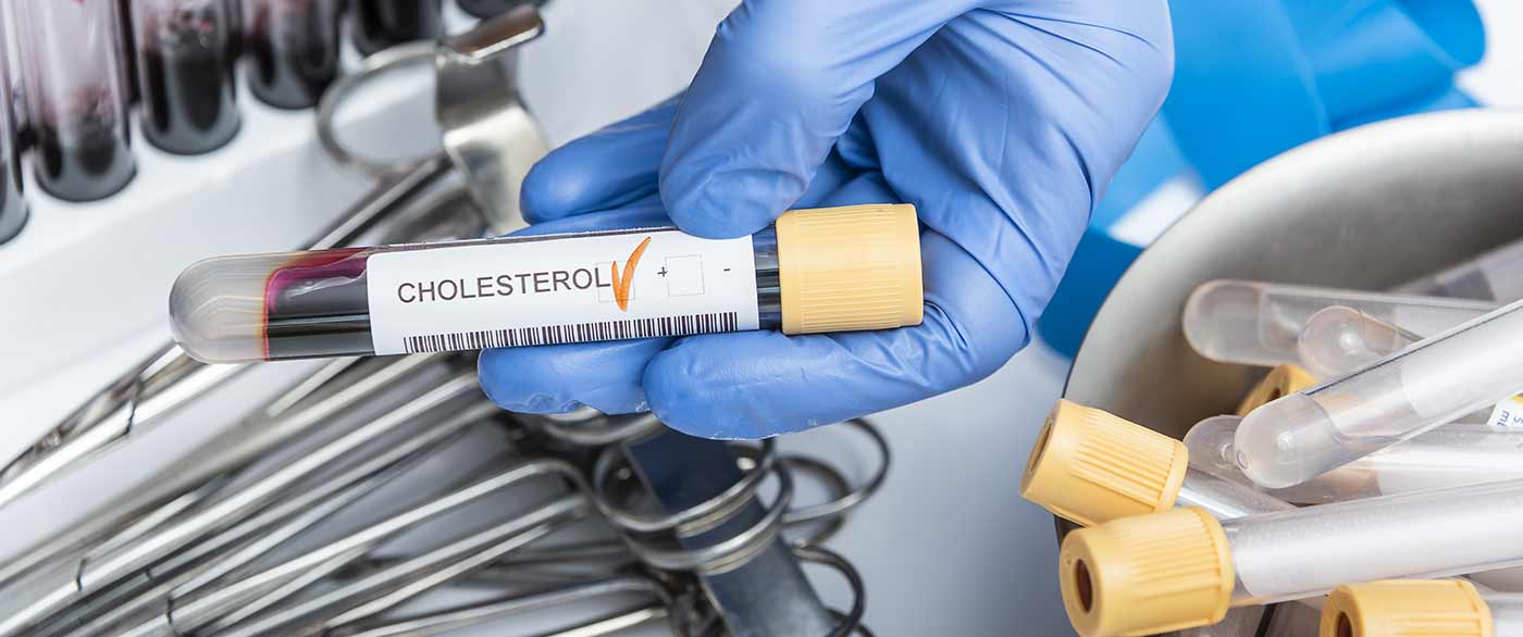 آزمایش Cholesterol