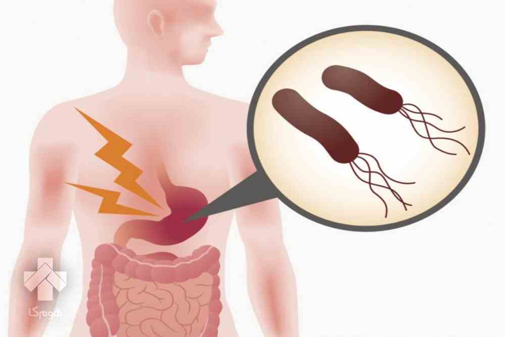 آزمایش H pylori Ag in stool