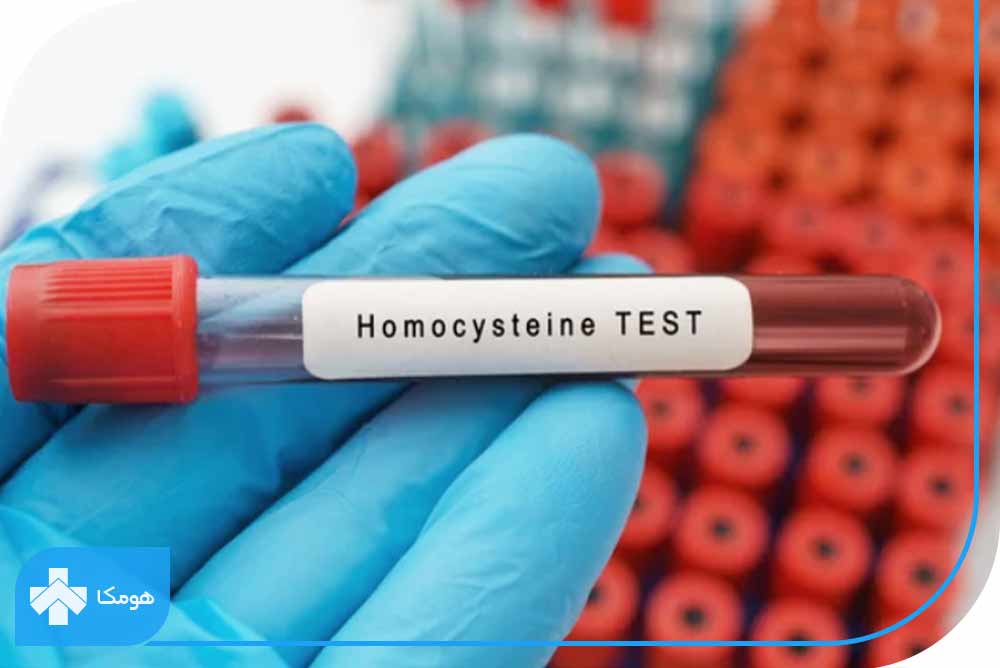 آزمایش Homocysteine