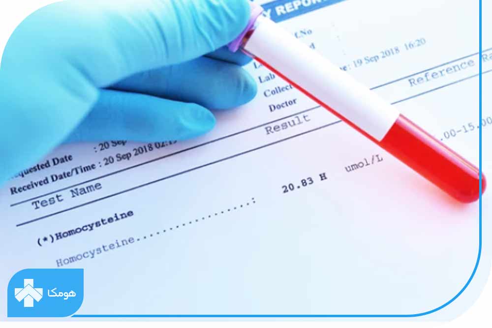 آزمایش Homocysteine