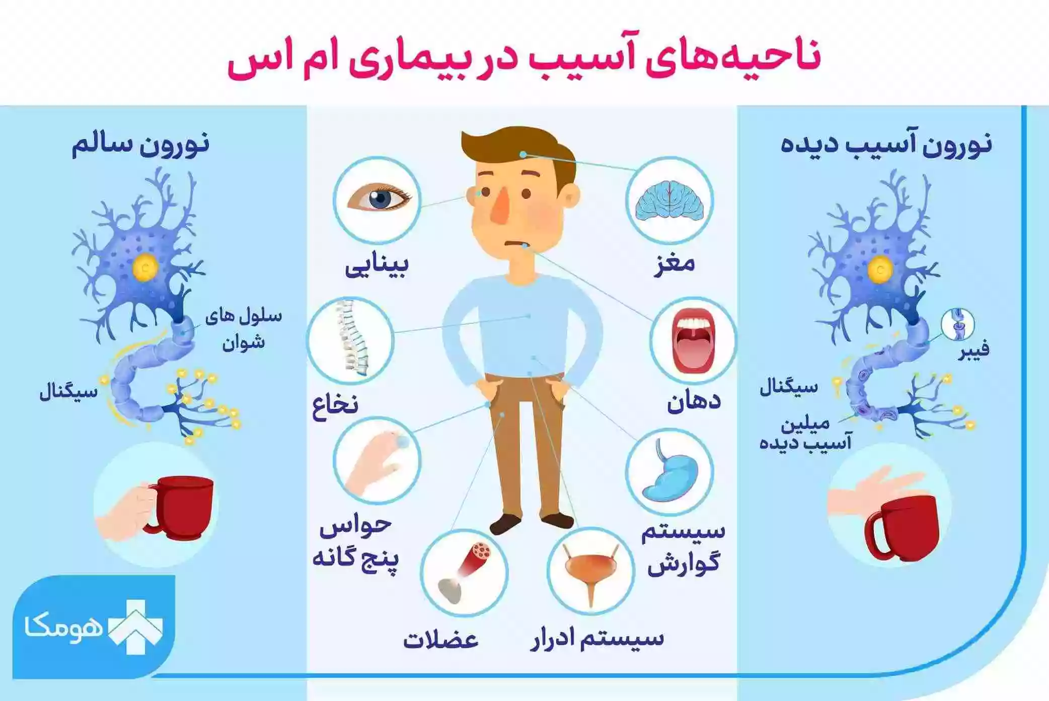 علائم ام اس