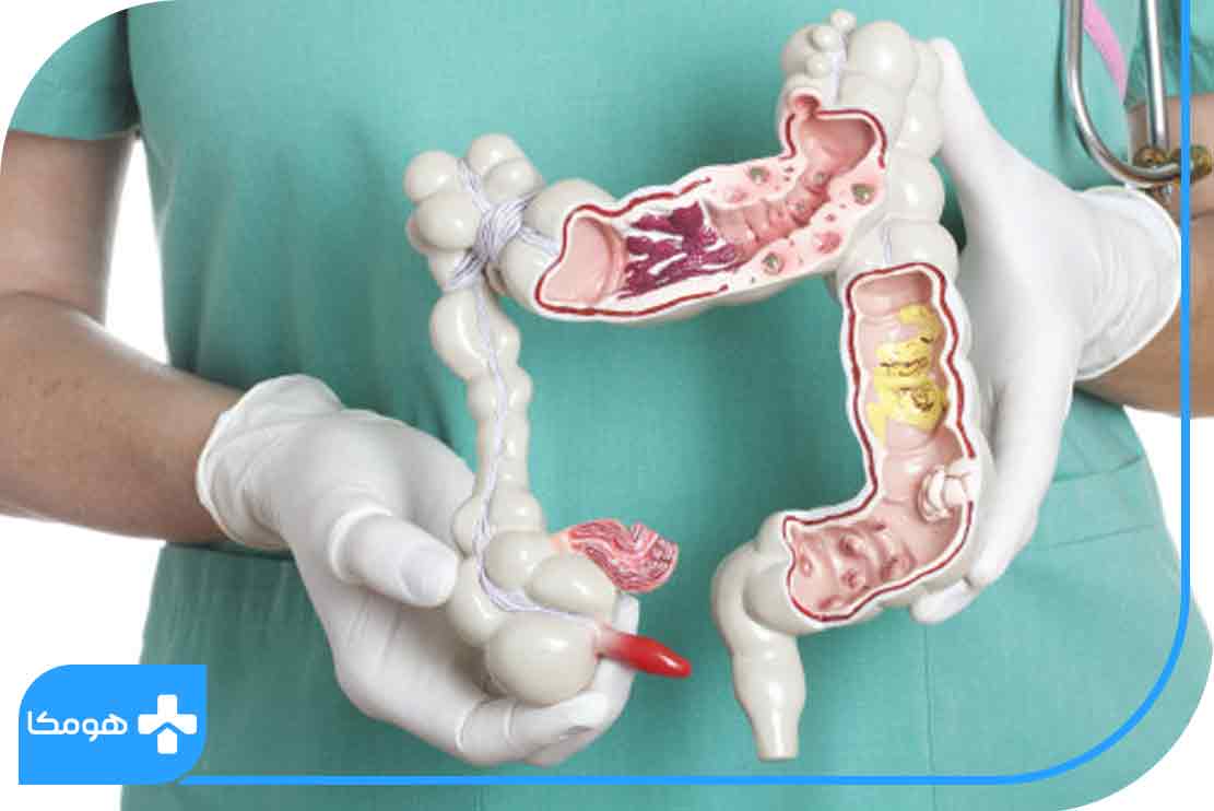 چرا به سرطان روده مبتلا می‌شویم؟