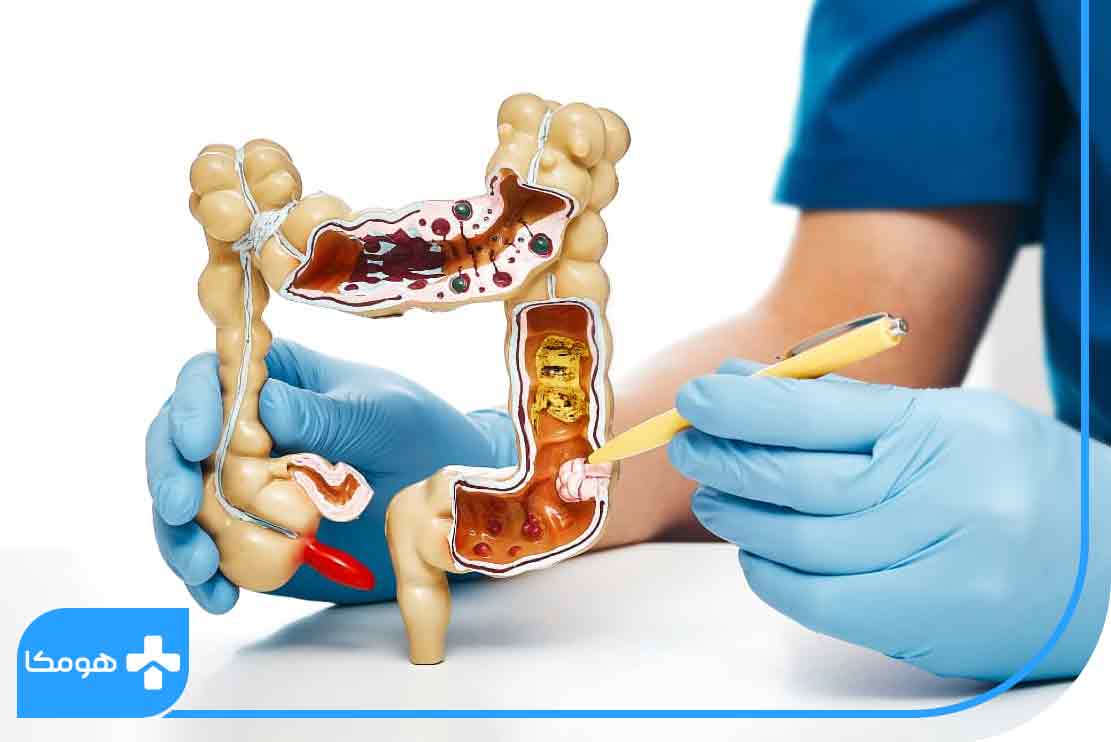 نشانه‌های اولیه سرطان روده